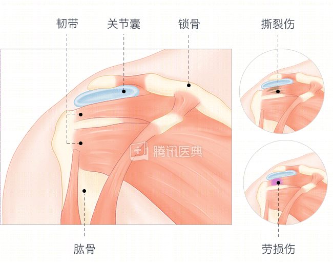 肩膀痛就是肩周炎吗？其实大部分不是，而是这个病！(图2)